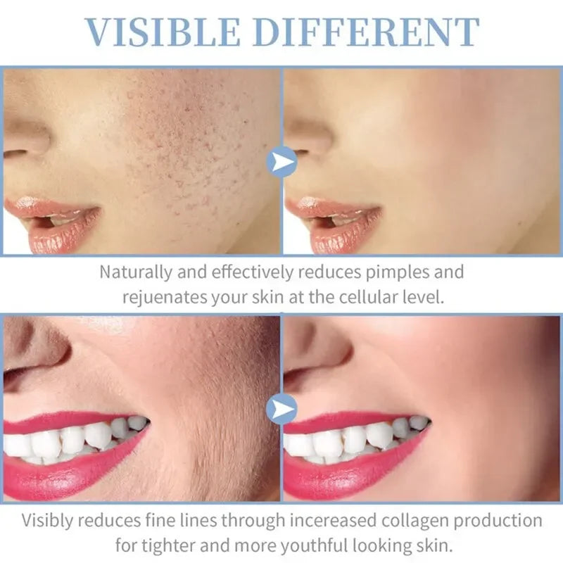 4-in-1 High Frequency Facial Machine - Professional Neon Wand for Acne Treatment